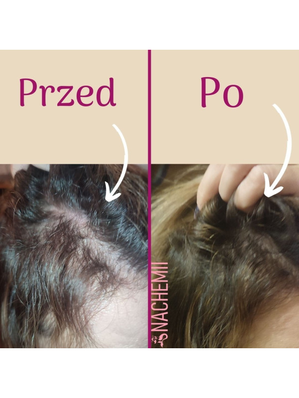 Serum stymulujące na porost włosów po chemioterapii Nachemii 100 ml